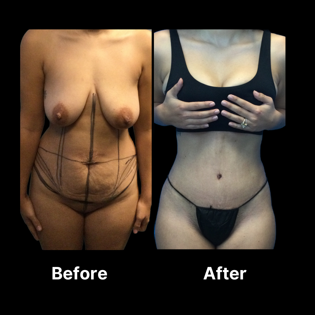 How long after surgery should I wear a girdle for a tummy tuck